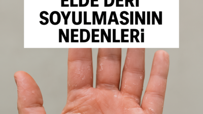 El soyulması; soğuk hava, egzama, vitamin eksikliği ve kimyasal teması