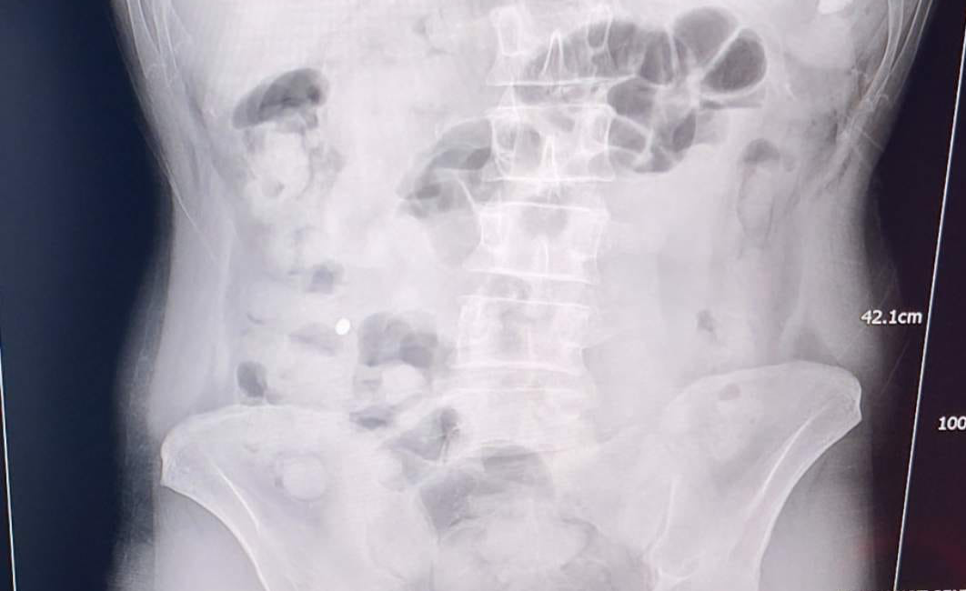 Uşak’ta yürütülen operasyon kapsamında İran uyruklu 2 şüphelinin mide ve